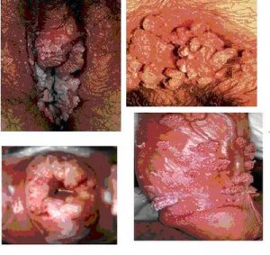 Epidemiología del Virus del Papiloma Humano | Blog del Dr. Santiago Díaz  Risco